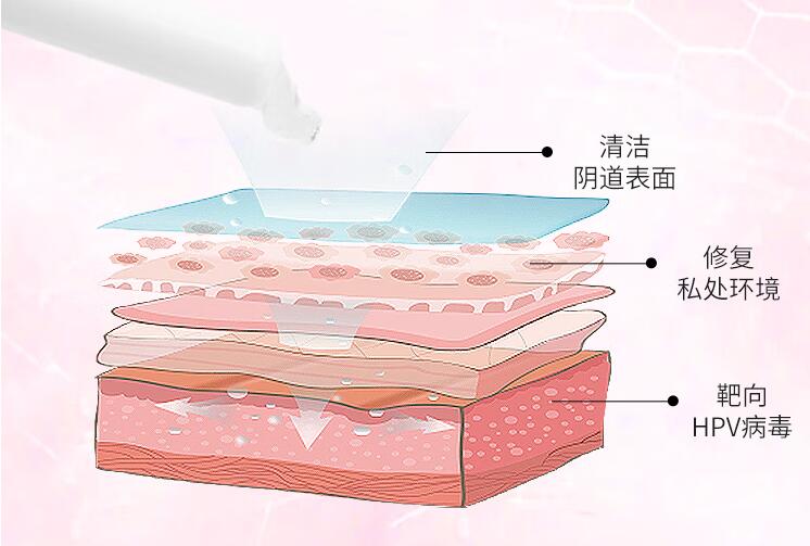 抗HPV生物凝胶敷料：告别尖锐湿疣，迎接健康生活