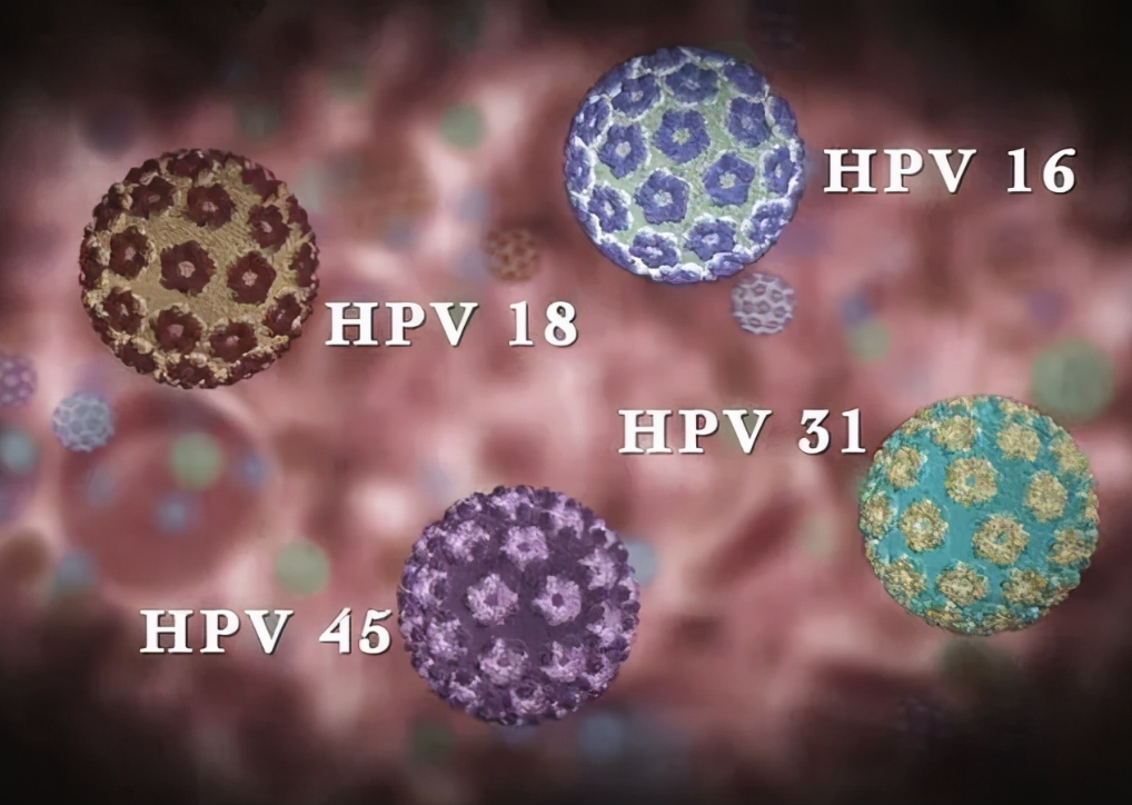 高危hpv感染是怎么回事？